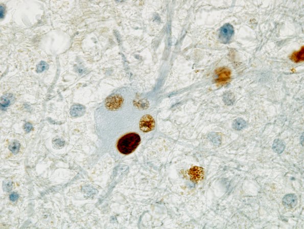 8B6 PML (Case 12) IHC Papova-BK virus large T Ag 5