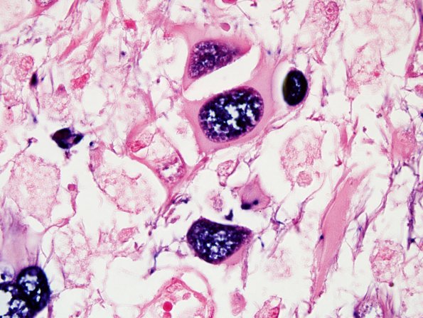 9A3 Bizarre astrocytes (Case 15) N14 ISH 13