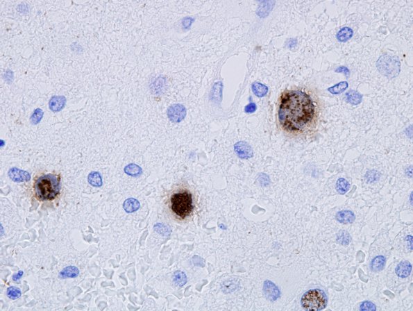 9A4 PML, + control ISH (Case 16) 100X 1