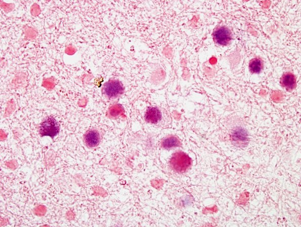 9A9 PML (Case 13) JCV-ISH 2