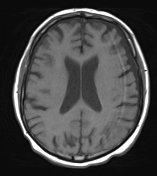 0A2 PML (Case 1) T1 no contrast 2 - Copy