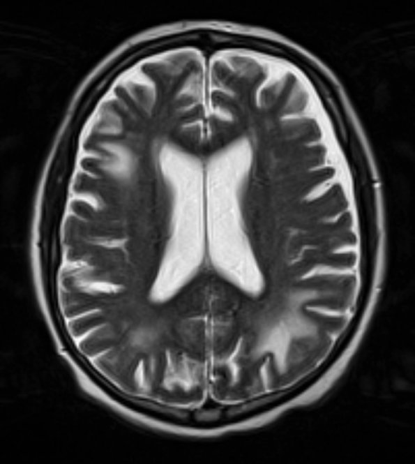 0A3 PML (Case 1) T2 no contrast 1 - Copy