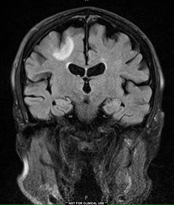 0A4 PML (Case 1) T2 Pre no contrast 2 - Copy