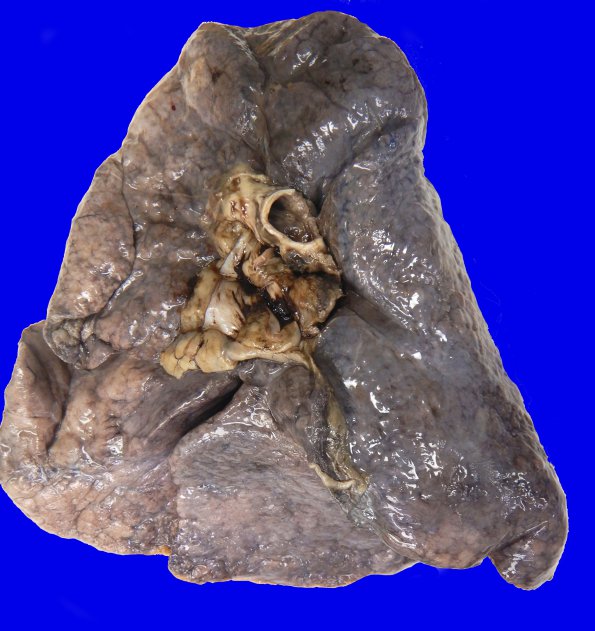 1A1 Lung (Case 1) hilar adenopathy