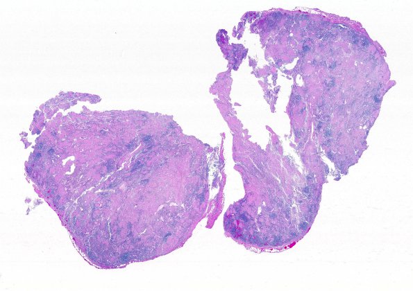 1A2 Sarcoid case with PML (Case 1) 1YH right C