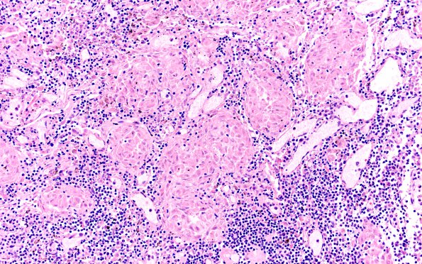 1A3 Sarcoid & PML (Case 1) Hilar Lymph node 1YH 20X