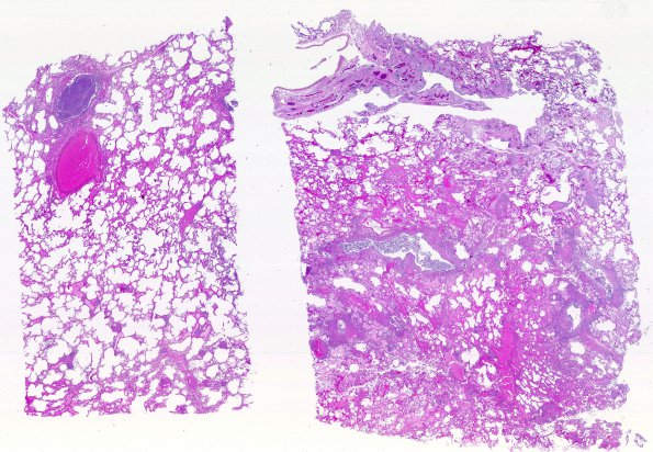 1A4 Sarcoid case with PML (Case 1) 1EU - 1