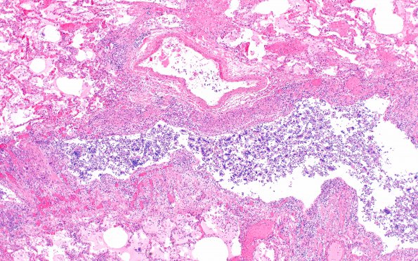 1A5 PML (Case 1) Lung 1EU 4X