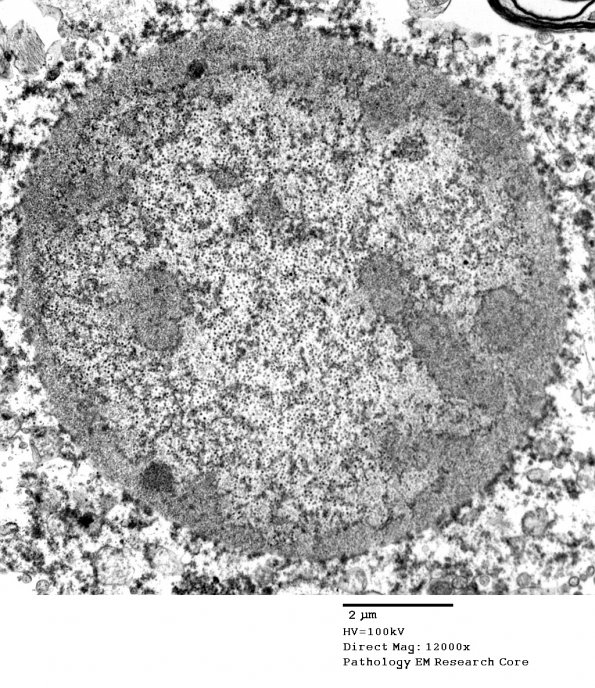 2I1 PML (Case 2) N6 peduncle EM 055 - Copy - Copy