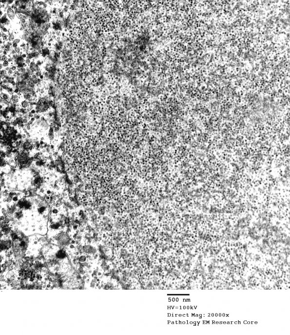 2I2 PML (Case 2) N6 peduncle EM 033 - Copy - Copy