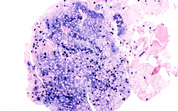 2J1 PML (Case 1) JC-ISH Oligo area 10X