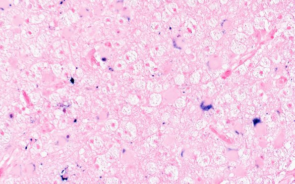 2K1 PML (Case 1) JC-ISH Astrocytic area 40X 3