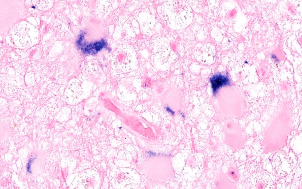 2K2 PML (Case 1) JC-ISH&E Astrocytic area 100X 2