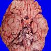 3A1 (Case 1) No sarcoid lesions