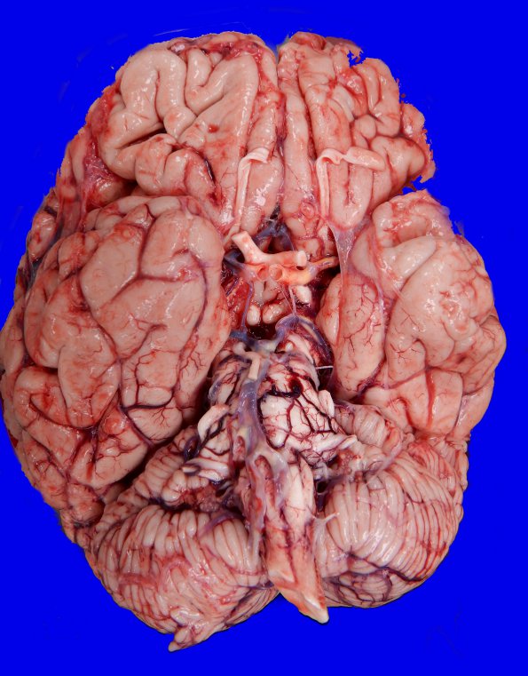 3A1 (Case 1) No sarcoid lesions