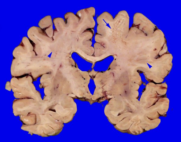 3A2 PML (Case 1)_1 copy