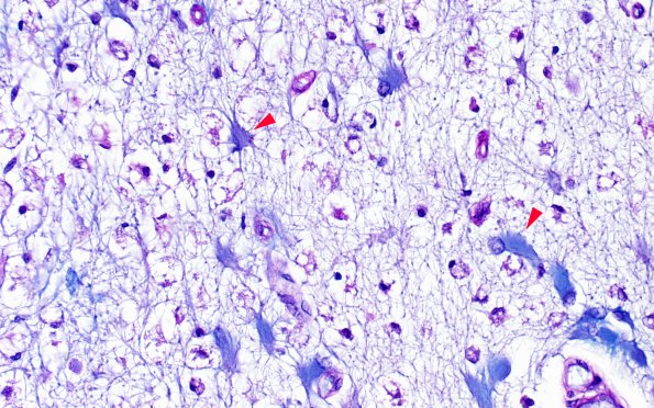 3B2 PML (Case 1) N5 Match with LFB-PAS 40X copy