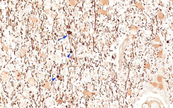 3C2 PML (Case 1) N5 Match with LFB-PAS NF 40X copy 4