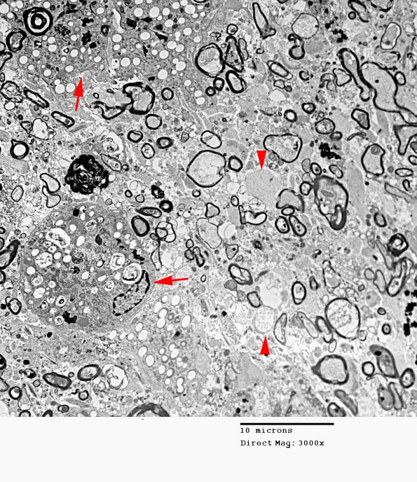 1B1 PML (Case 1) EM 019A copy - Copy A