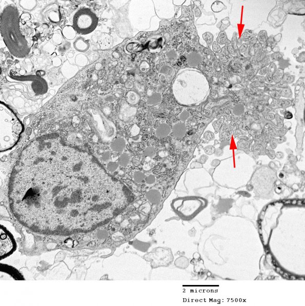 2A1 PML (Case 2) EM 003 copy - Copy