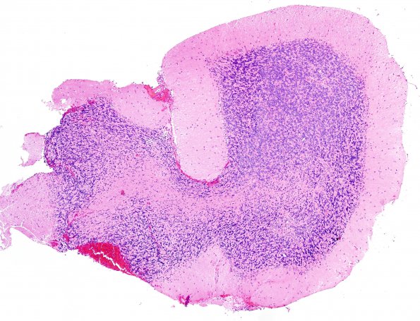 1A1 PML, Granule cell pattern (Case 1 surgical specimen) H&E 4X