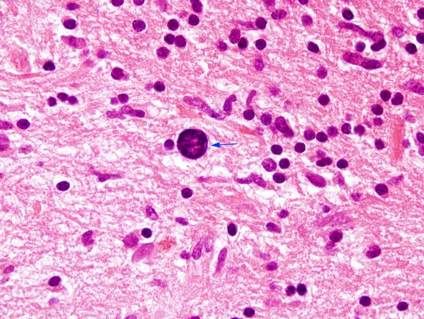 1A4 PML, Granule cell pattern (Case 1 surgical specimen) H&E 2 copy