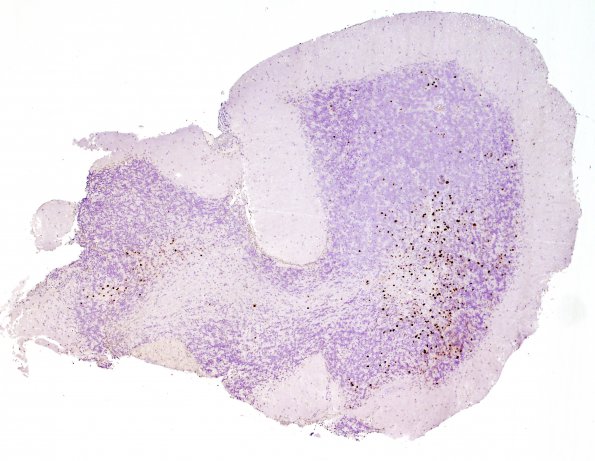 1B1 PML, Granule cell pattern (Case 1 surgical specimen) anti-SV-40 4X