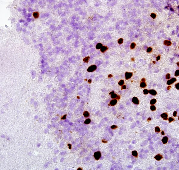 1B2 PML, Granule cell pattern (Case 1 surgical specimen) area A SV40 100X 3