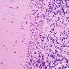 1C1 PML, Granule cell pattern (Case 1 surgical specimen) area A H&E 40X