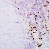 1C2 PML, Granule cell pattern (Case 1 surgical specimen) area A SV40 40X copy