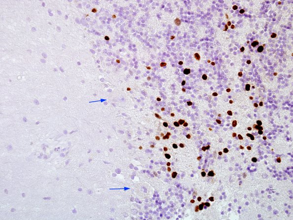 1C2 PML, Granule cell pattern (Case 1 surgical specimen) area A SV40 40X copy