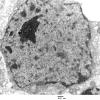 1D Case 1 surgical specimen EM 008 - Copy