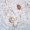 1E1 PML, Granule cell pattern (Case 1 surgical specimen) CD3 20X 2