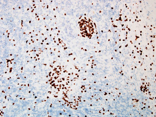 1E1 PML, Granule cell pattern (Case 1 surgical specimen) CD3 20X 2