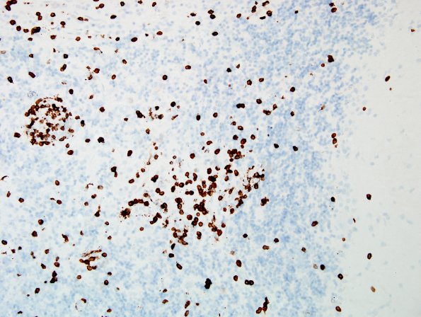 1E2 PML, Granule cell pattern (Case 1 surgical specimen) CD8 20X 1