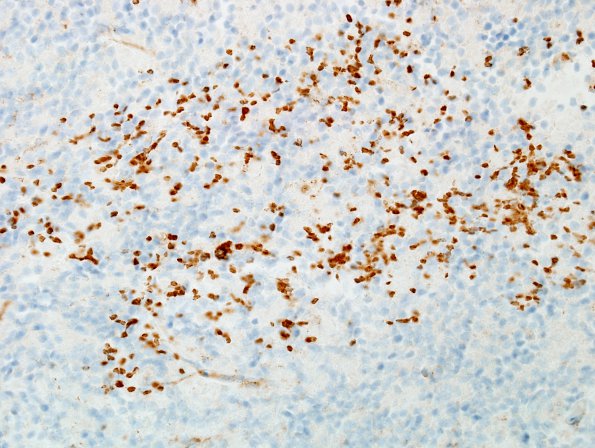 1E3 PML, Granule cell pattern (Case 1 surgical specimen) CD4 40X 1