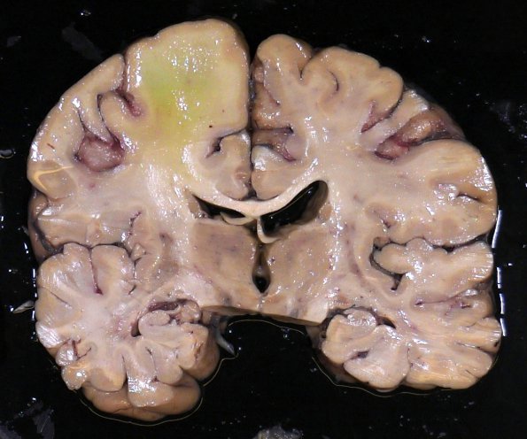 1F1 PML, R cerebellum (Case 1 Autopsy specimen) _10