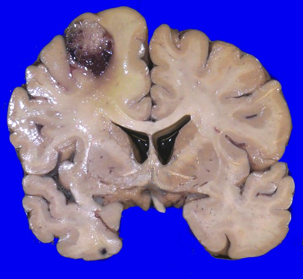 1F2 (Case 1 Autopsy specimen) Gross Pathology_4A