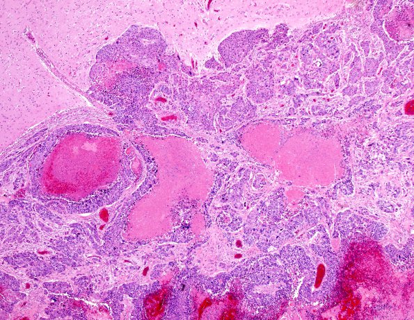 1F3 Metastasis, JC Neuronopathy (Case 1 Autopsy specimen) N11 H&E 4X