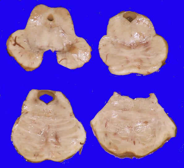 1F4 (Case 1 Autopsy specimen) Gross Pathology_15AA