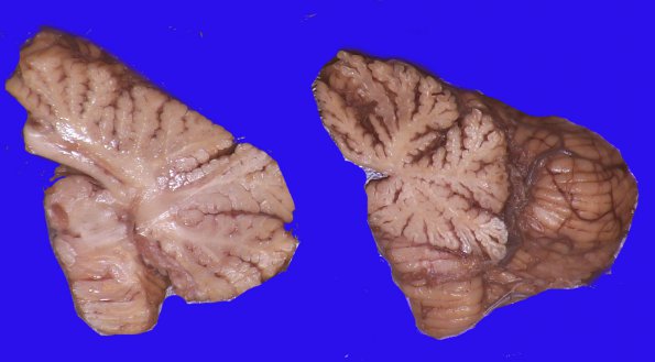 1F5 (Case 1 Autopsy specimen) Gross Pathology_11AA