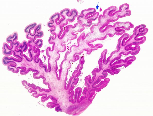 1G1 PML, cerebellar vermis (Case 1 Autopsy specimen) N14 H&E whole mount copy