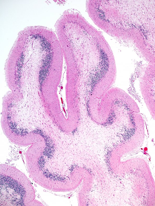 1G2 PML, cerebellar vermis (Case 1 Autopsy specimen) N14 H&E 3