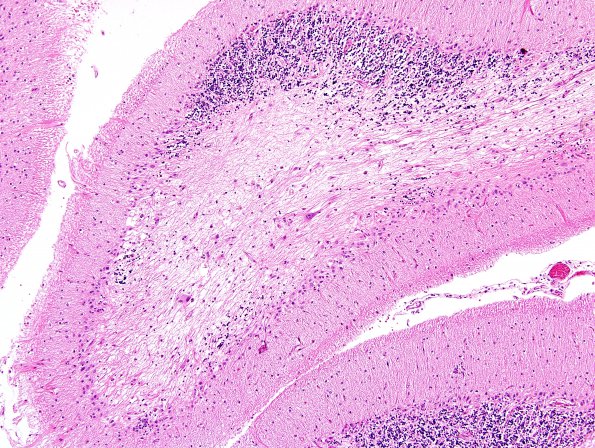 1G3 PML, R cerebellum (Case 1 Autopsy specimen) N14 H&E 10X 1