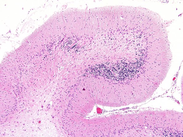 1G4 PML, R cerebellum (Case 1 Autopsy specimen) N14 H&E 10X 3