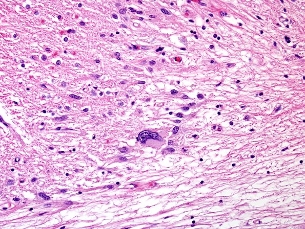 1G5 PML, R cerebellum (Case 1 Autopsy specimen) N14 H&E 7 (2)