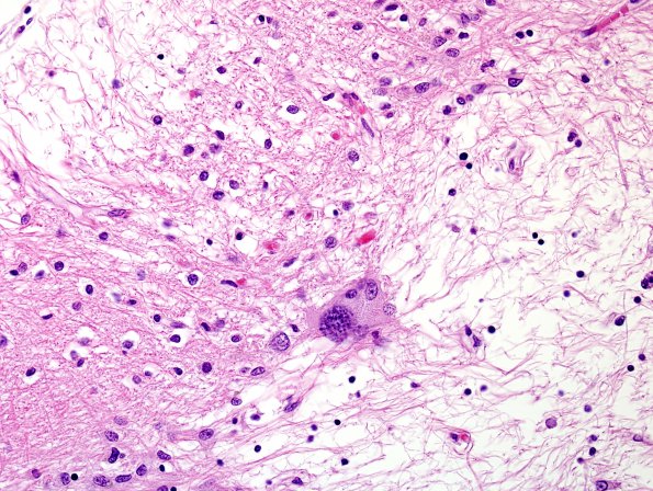 1G6 PML, R cerebellum (Case 1 Autopsy specimen) N14 H&E 9