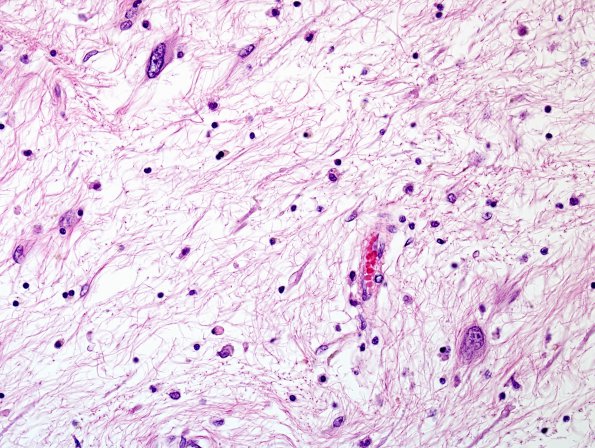 1G7 PML, R cerebellum (Case 1 Autopsy specimen) N14 H&E 7 (3)