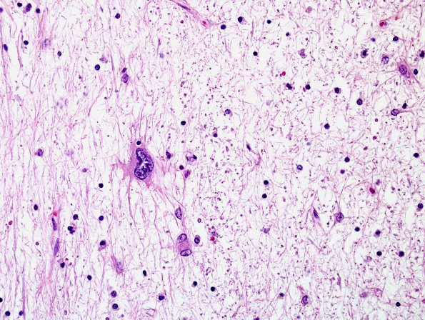 1G8 PML, R cerebellum (Case 1 Autopsy specimen) N14 H&E 2