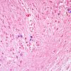 1H2 Granule cell neuronopathy (Case 1 Autopsy specimen) N14 JCV ISH 6 copy